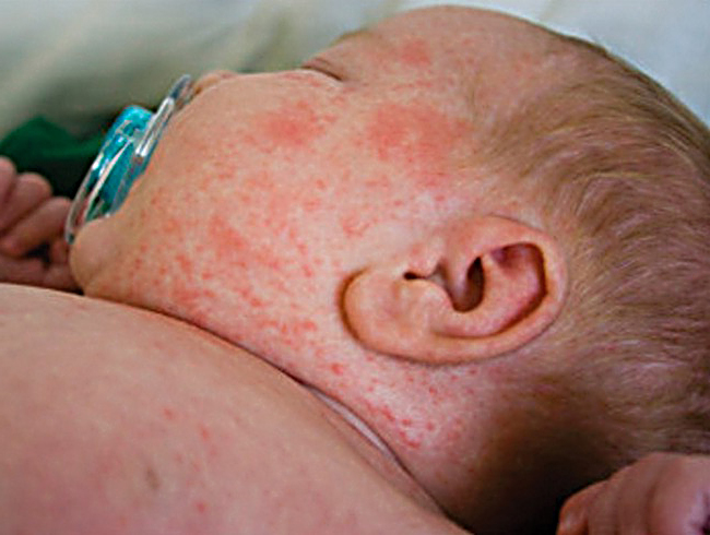 Три бебиња помали од шест месеци заболени од морбили