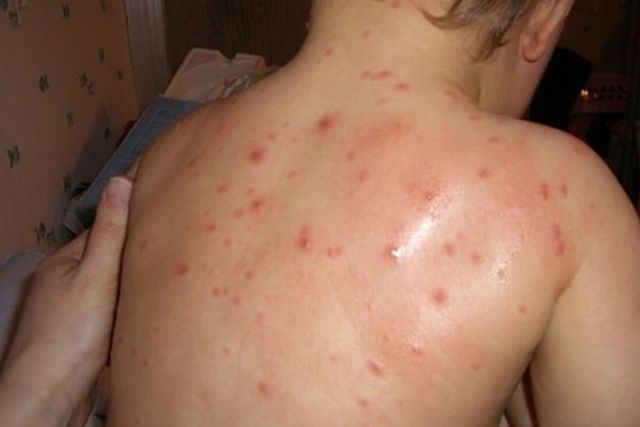 Зголемен бројот на заболени деца од варичела во Куманово