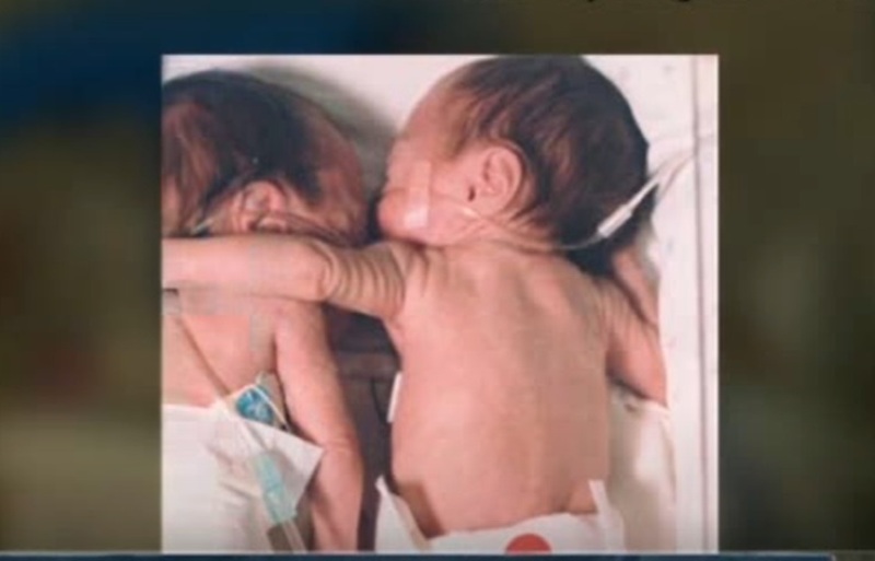 Божјо чудо:Предвреме родено бебе на смртната постела ја прегрнало својата близначка но потоа се случило нешто…
