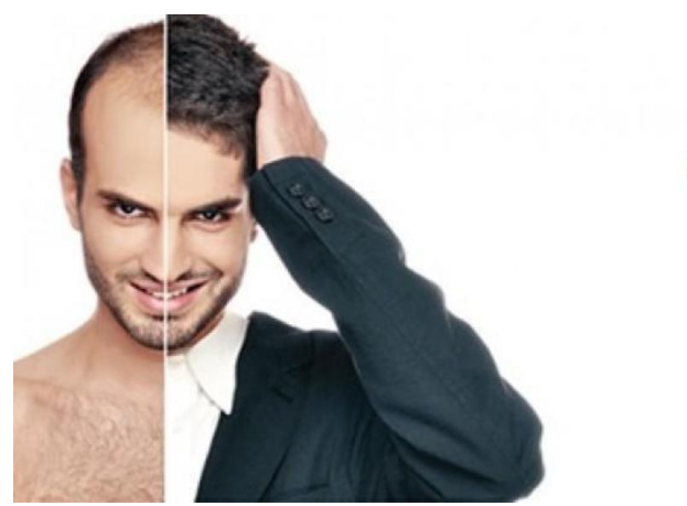 Министри и пејачи си пресадуваат коса: Овие македонски познати личности се спасија од ќелавост!