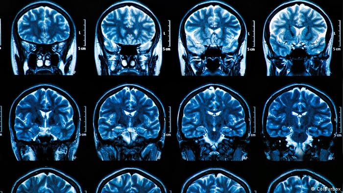 Невролозите укажуваат на „облак“ во меморијата и автоимуни болести како последица на Омикрон