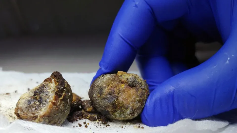 Исфрлање камења од жолчката без операција – со природен лек од маслиново масло и магнезиум