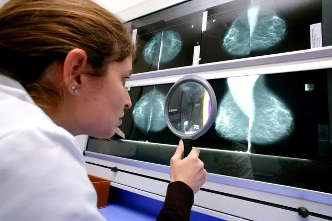 Вештачка интелигенција открила рак на дојка четири години однапред