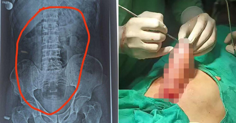 Вознемирувачко фото: Хирурзи не верувале што пронашле во тело на пациент