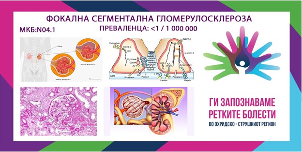 Ги запознаваме ретките болести во охридско – струшкиот регион: Фокална сегментална гломерулосклероза