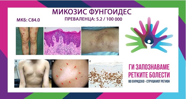 Ги запознаваме ретките болести во охридско-струшкиот регион: Mикозис фунгоидес