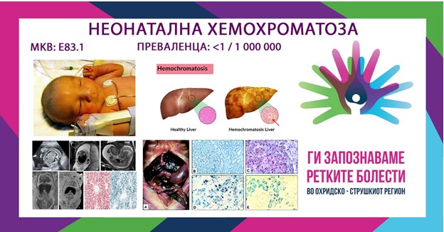 Ги запознаваме ретките болести во охридско-струшкиот регион: Неонатална хемохроматоза