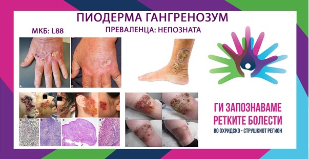 Ги запознаваме ретките болести во охридско-струшкиот регион: Гангренозна пиодермија