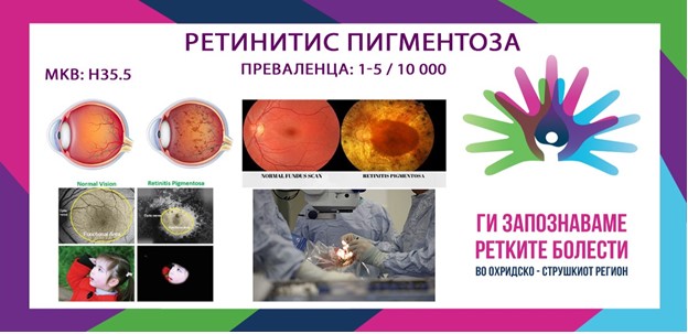 Ги запознаваме ретките болести во охридско-струшкиот регион: Ретинитис пигментоза