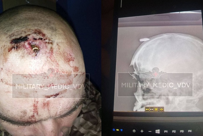 Руски војник преживеал затоа што куршумот не успеал да му го пробие черепот и му се заглавил во челото